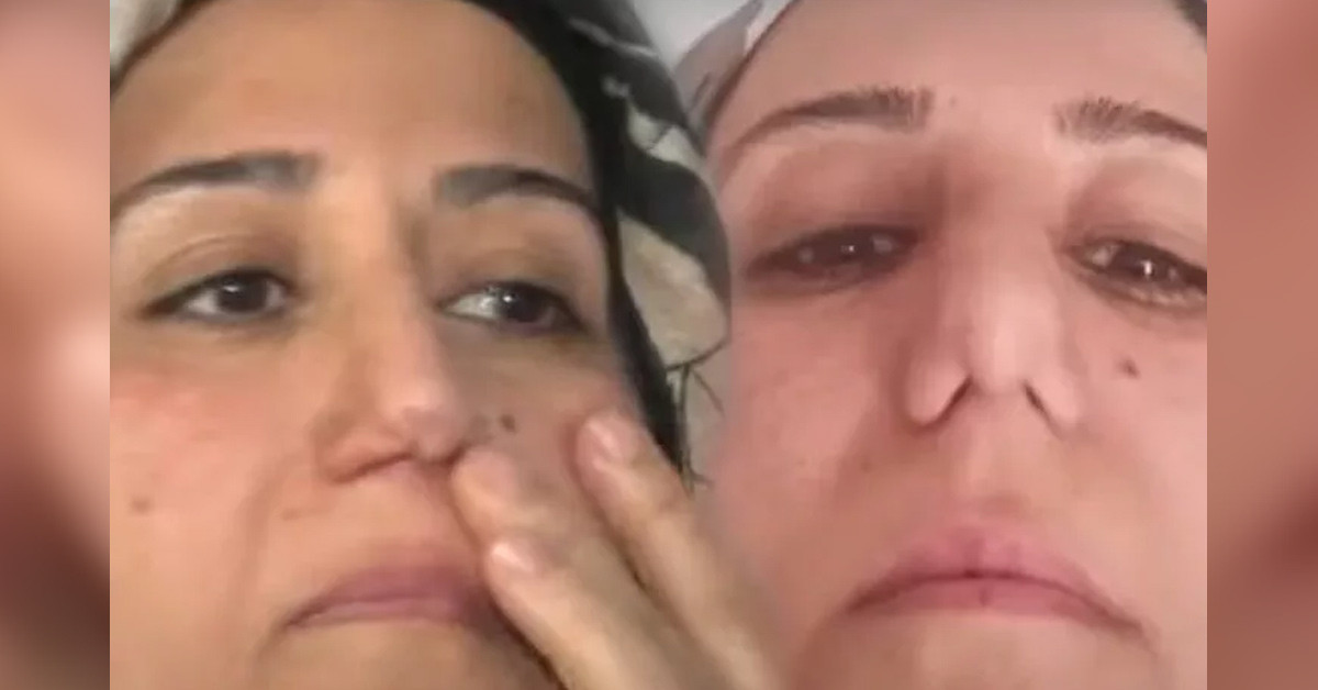 Yanlışlıkla burun delikleri dikildi