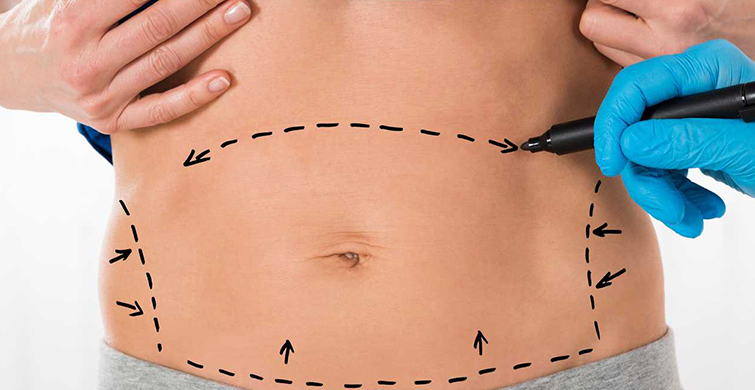  Liposuction Kilo Verdirmek Düşüncesi İle Uygulanıyor