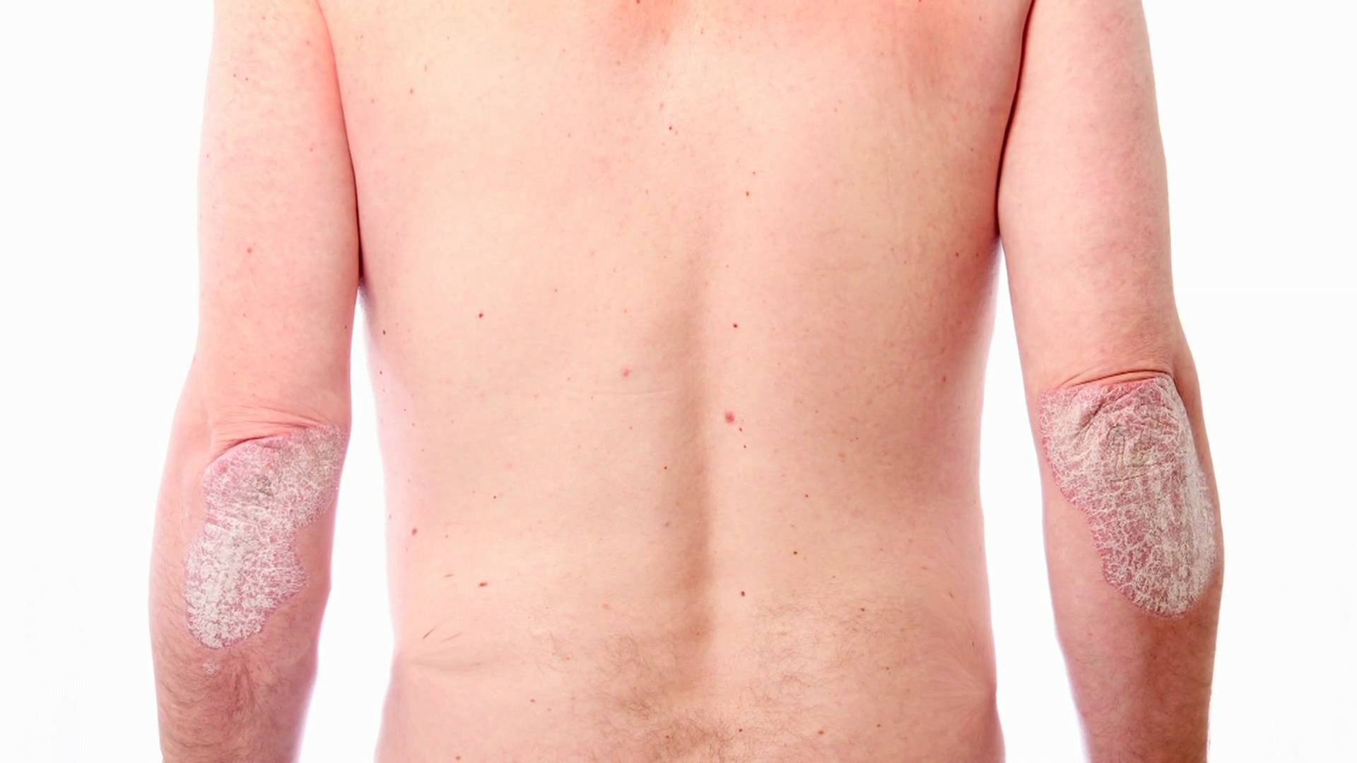 SEDEF HASTALIĞI NEDİR?