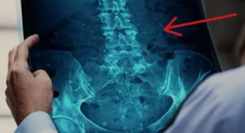 3 gündür tuvalete çıkamayan adamın makatından pet şişe çıktı! Meğer karısından utandığı için...