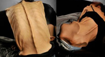 Anoreksiyaya yakalanan genç kadın 18 kiloya düşmüştü! Şimdi ki hali görenleri şaşırttı