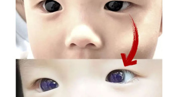 Bilim insanlarını korkutan olay: Küçük çocuğun kahverengi gözleri bir anda parlak maviye dönüştü, nedeni ise…