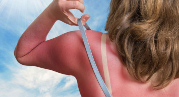 Güneş Alerjisi Belirtileri Neler, Güneş Alerjisi Nasıl Geçer?