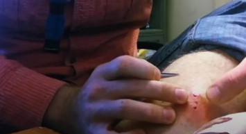 Kolunsaki şişlik yüzünden doktora gitti hayatını şokunu yaşadı: Sivilce zannetmişti ama öyle bir şey çıktı ki