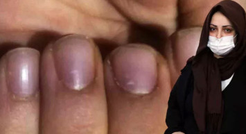 Sakarya'da ilginç bir vaka! Elleri ayakları bir anda morarıyor hastalığının adı bile yok