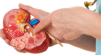 Sıcak Günlerde Giderek Artıyor! Böbrek Taşı Oluşumuna Dikkat