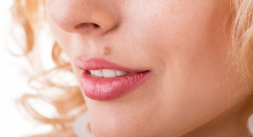 Siğil Nasıl Geçer, Siğilden Kurtulmanın Doğal Yolları Nelerdir?