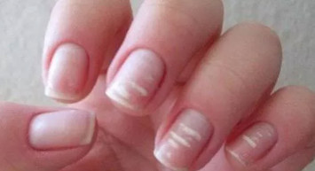 Tırnaktaki beyaz leke bakın neyin habercisi