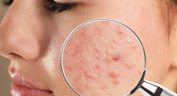 Yüzde oluşan sivilcelerin bölgelere göre nedenleri!