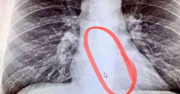 Boğaz Kuruluğu Şikayetiyle Doktora Gitti Hayatının Şokunu Yaşadı