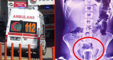 'Bu buraya nasıl girdi?' diyeceğiniz birbirinden garip röntgen filmleri!