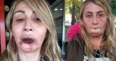Estetik Ameliyatı Oldu, Son Haliyle Çok Konuşuldu!