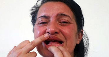 Dişlerini Beyazlatmak İsterken Hayatı Cehenneme Dönen Sunay Öztürk 