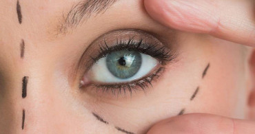 Botox Yaptırmadan Kaz Ayaklarından 5 Adımda Kurtulun