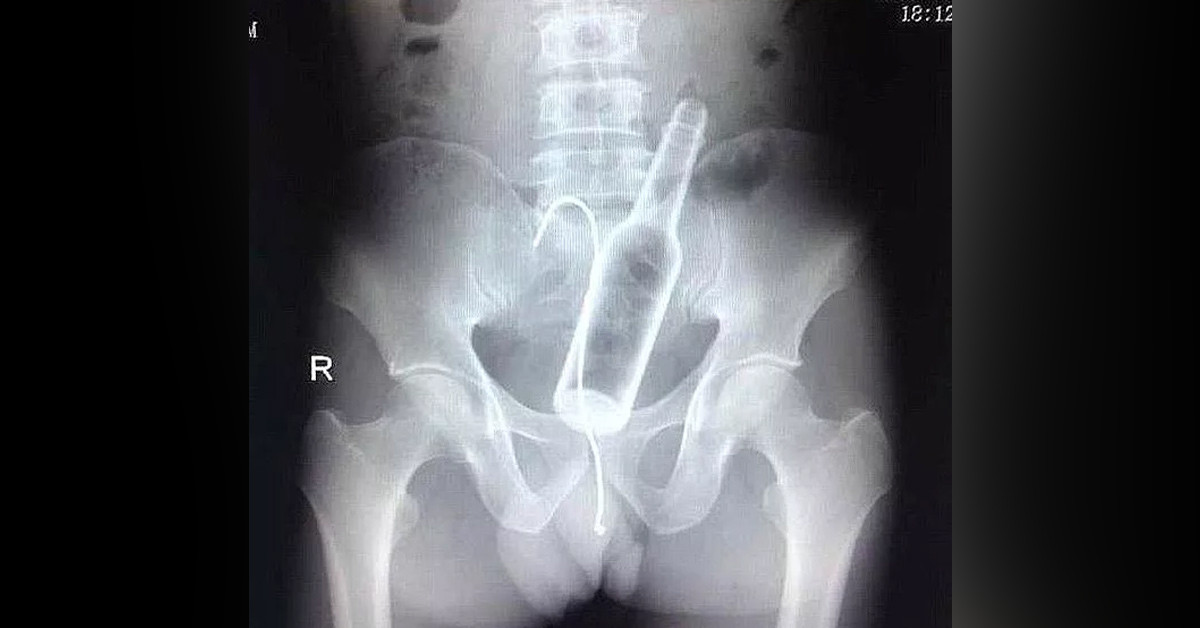 Şişe çıkarıldı