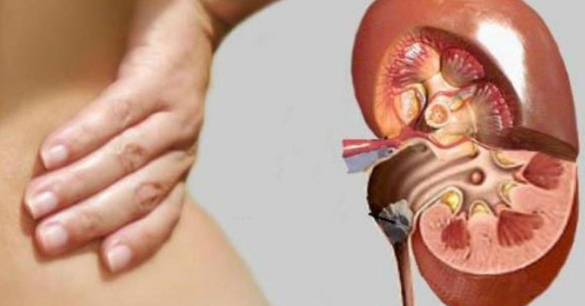 BÖBREK TAŞI BELİRTİLERİ