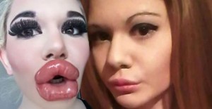 Barbie Bebeğe Benzemek İsteyen Genç Kadın 20 Kere Dudak Dolgusu Yaptırdı
