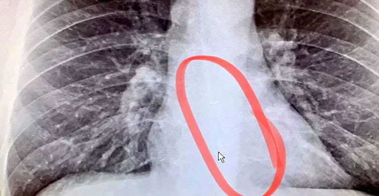 Boğaz Kuruluğu Şikayetiyle Doktora Gitti Hayatının Şokunu Yaşadı