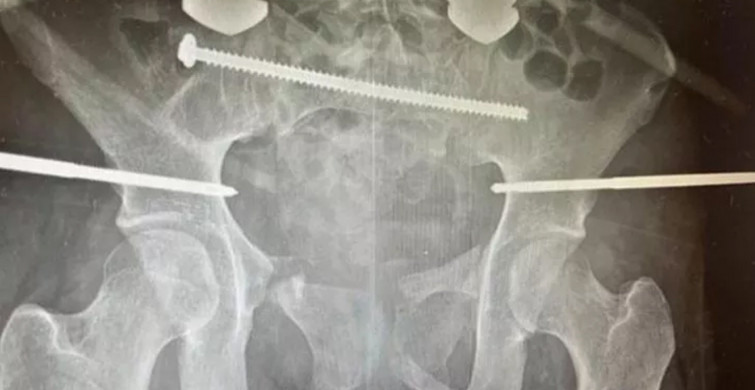 Böylesi daha önce görülmedi! Vücudu ikiye ayrılan kadın için doktorlar yaşama ihtimali yüzde sıfır demişti son hali herkesi şaşırttı