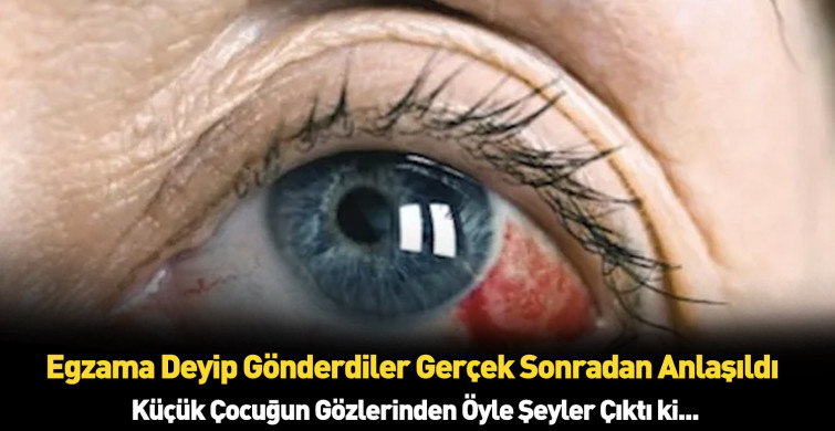 Egzama dediler kasık biti çıktı: Küçük çocuğın başına gelmeyen kalmadı!