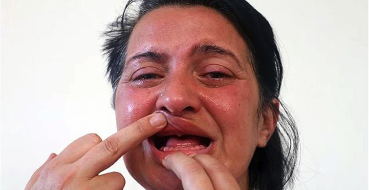 Dişlerini Beyazlatmak İsterken Hayatı Cehenneme Dönen Sunay Öztürk 