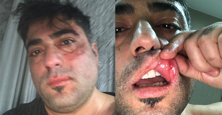 İzmir’de Kadın Eşinin Gözlerini Oymaya Çalıştı