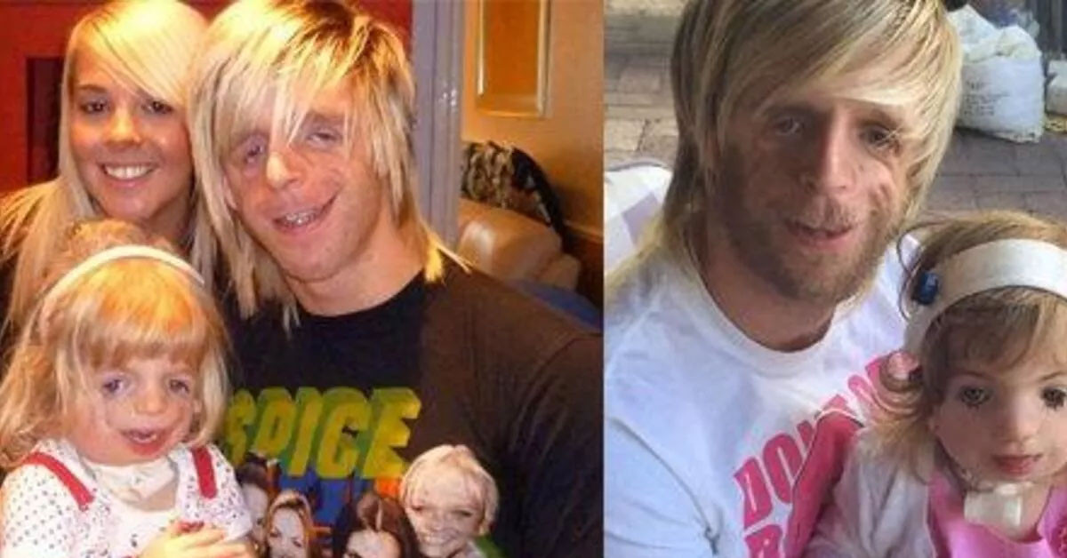 Elmacık kemikleri olamadan doğdu