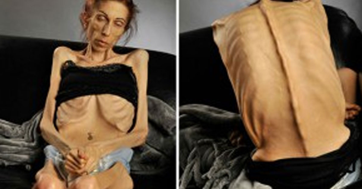 Anoreksiya hastalığına yakalandı