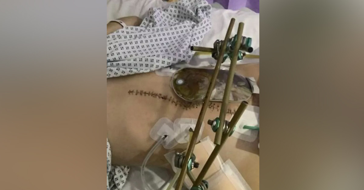 Ciddi kırıklar meydana geldi