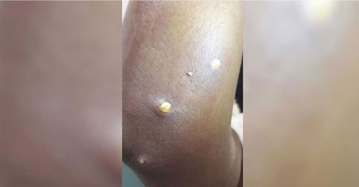 Larva oldukları ortaya çıktı