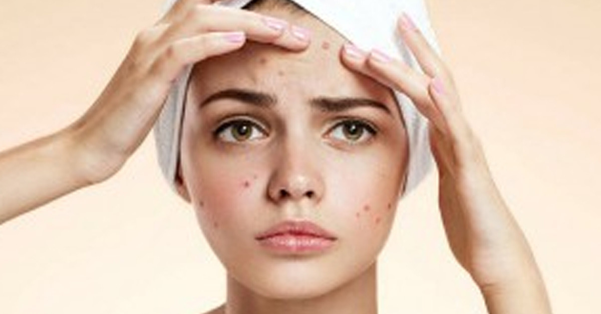 Yüzde oluşan sivilceler