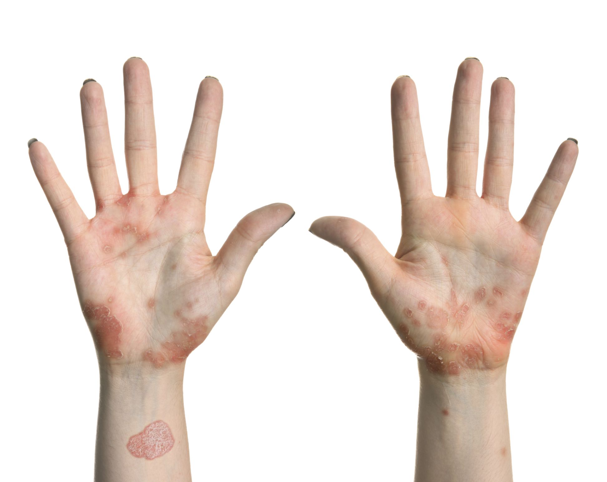 İLAÇTAN FARKLI TEDAVİ ÖNERİLERİ