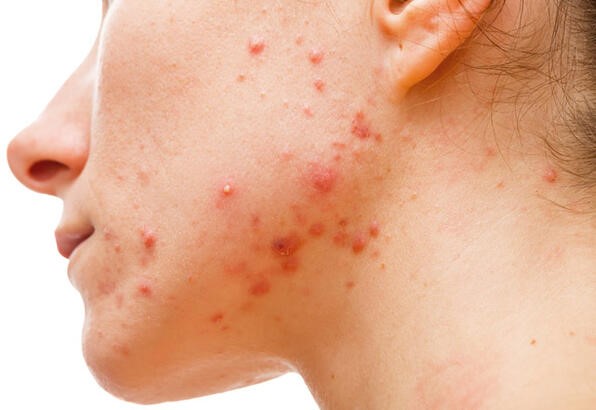 Akne Sorunları