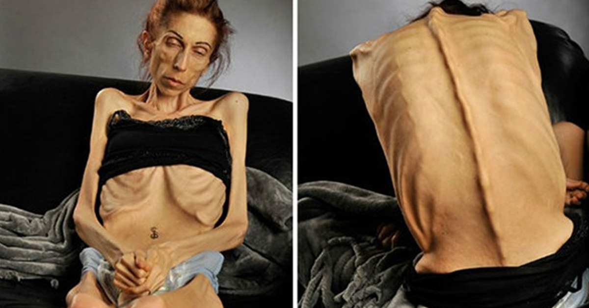 RİSKLİ OLDUĞU İÇİN TEDAVİ OLAMIYORDU