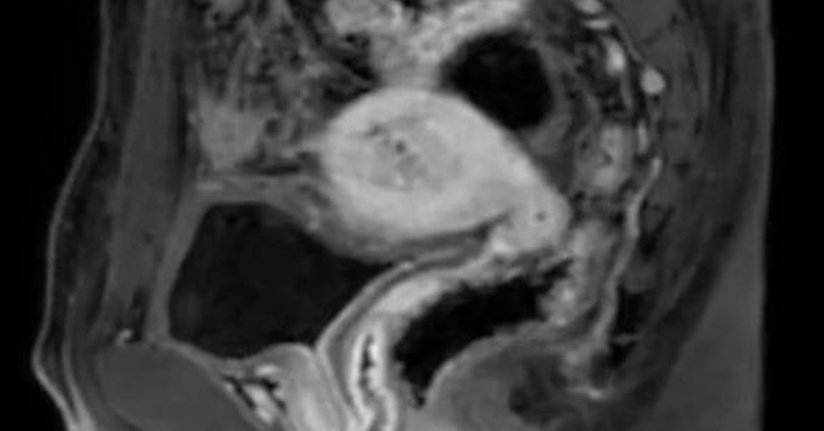 Rahmi ve yumurtalıkları çıktı