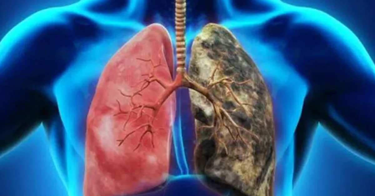 Akciğerlerin kirlenmesi