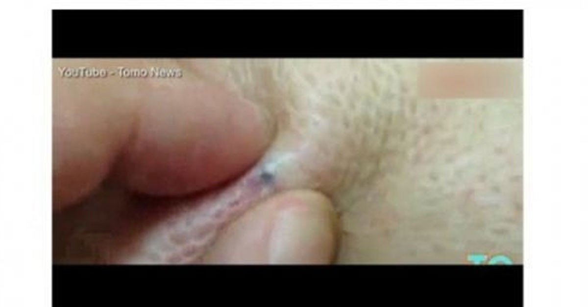 Ceraahi işlem uygulandı