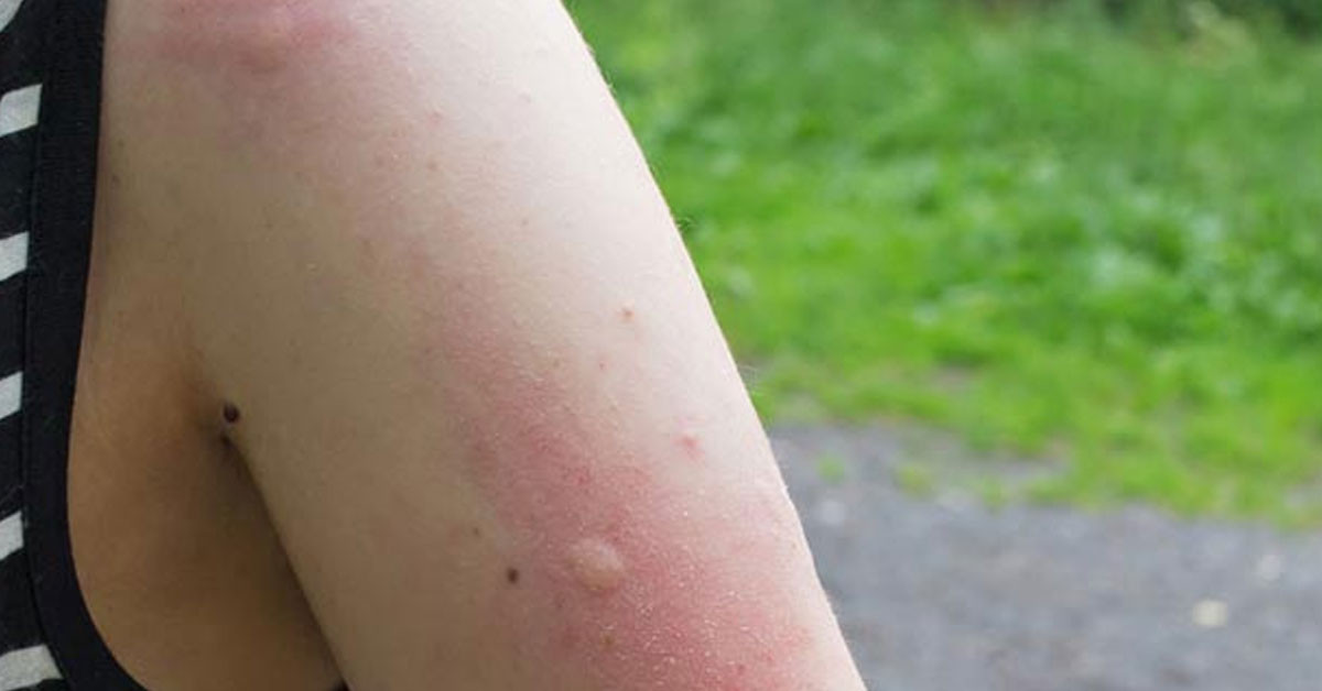 Sivrisinekler en çok kimi ısırır?