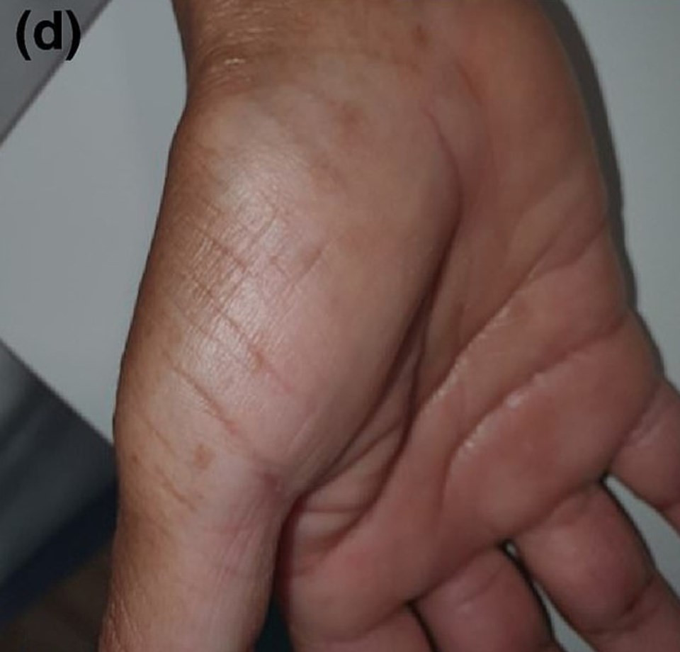 Hastaların Yüzde 40'ında Cilt Soyulması Meydana Geldi