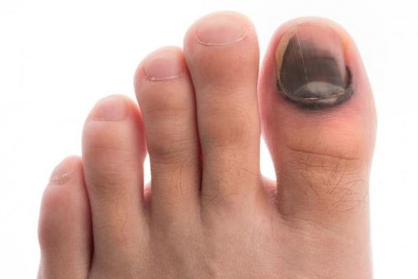 TIRNAK MANTARI NEDEN OLUR?