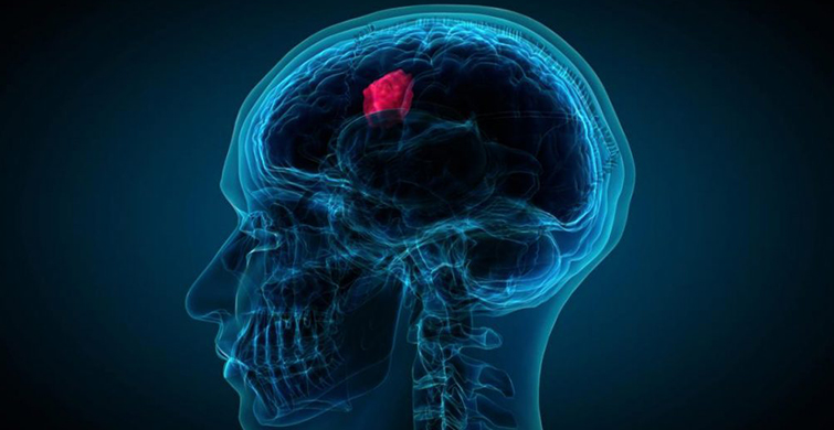 Tüm Tümörler Yorgunluk Belirtisi Gösteriyor