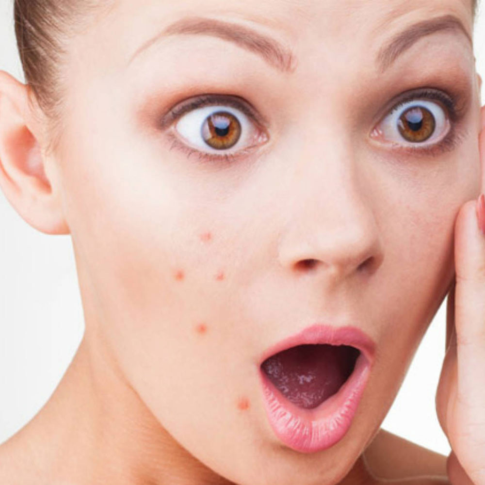 Sivilceler Neden Oluşur?