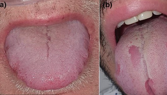 Hastaların Dörtte Birinde Dil Değişti