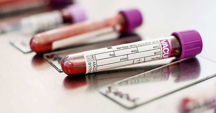Hepatit B