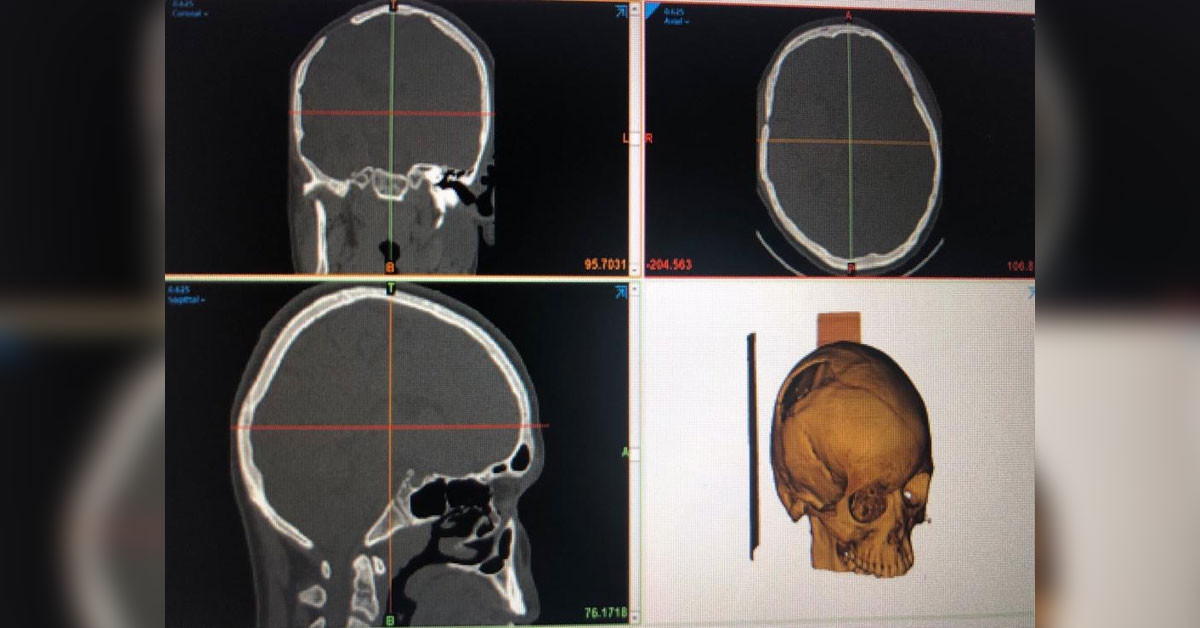 3 boyutlu yazıcıdan kemik implantı yapıldı 3 boyutlu yazıcıdan kemik implantı yapıldı