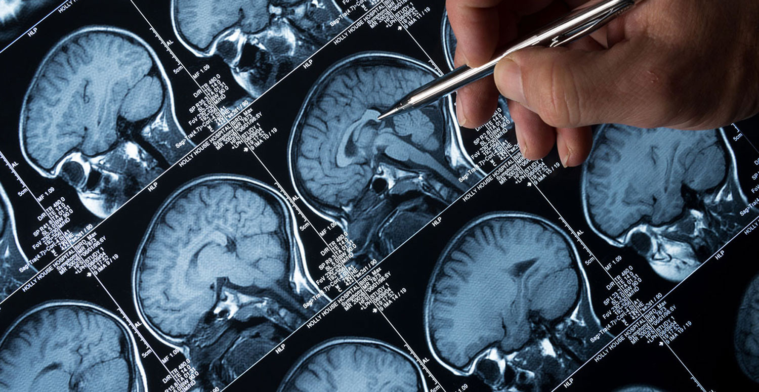 Epilepsi belirtileri nelerdir? Epilepsi belirtileri nelerdir?