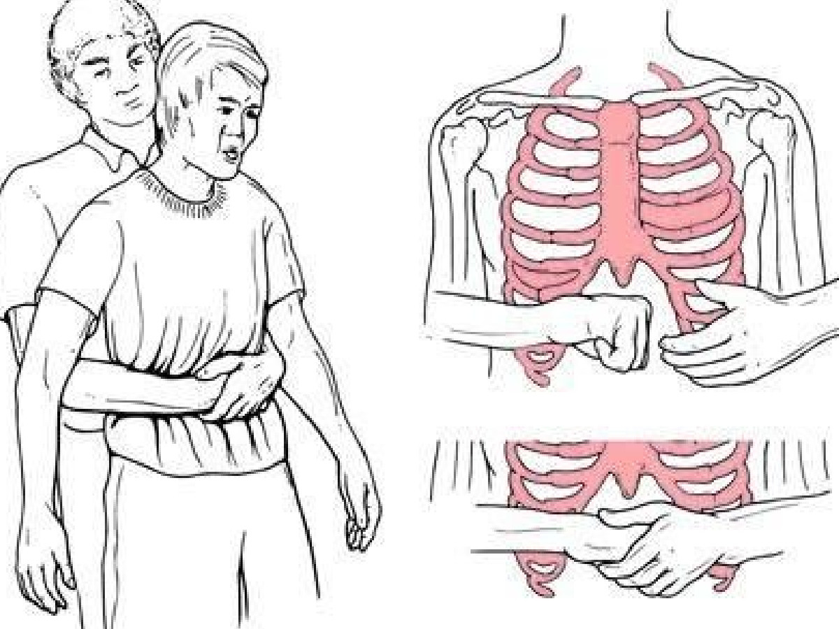 Heimlich manevrası nasıl yapılır?