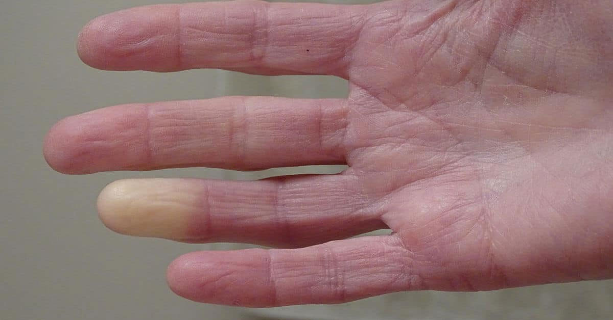 Raynaud hastalığı nedir?