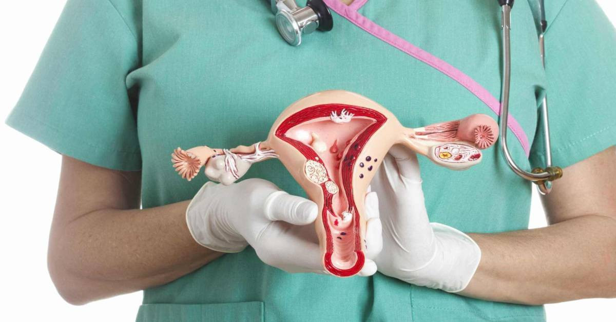 Endometriozis nedir, neden olur? Çikolata kisti nasıl geçer, patlarsa ne olur? Çikolata kisti belirtileri ve tedavileri