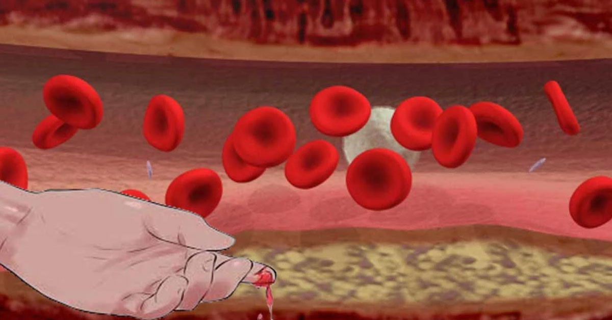 Genetik bir rahatsızlık olan hemofili hastalığına sahip bireylerin yaşam kalitesinin iyileşmesi adına Trakya Üniversitesi Tıp Fakültesi İç Hastalıkları ve Hematoloji Bilim Dalı Öğretim Üyesi Prof. Dr. Ahmet Muzaffer Demir, bakım ve tedavide çeşitli gelişmelerin yaşandığını fakat hala birçok karşılanmamış ihtiyacın olduğunun altını çizdi. Genetik bir rahatsızlık olan hemofili hastalığına sahip bireylerin yaşam kalitesinin iyileşmesi adına Trakya Üniversitesi Tıp Fakültesi İç Hastalıkları ve Hematoloji Bilim Dalı Öğretim Üyesi Prof. Dr. Ahmet Muzaffer Demir, bakım ve tedavide çeşitli gelişmelerin yaşandığını fakat hala birçok karşılanmamış ihtiyacın olduğunun altını çizdi.